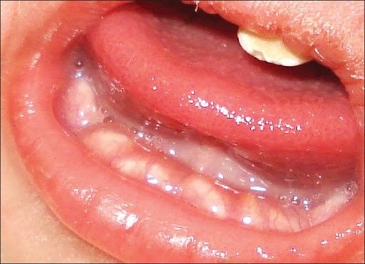 Nhiều răng bẩm sinh là tình trạng hiếm gặp