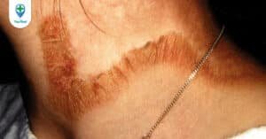 Bệnh Pellagra: những điều cần biết khi bị thiếu hụt Vitamin B3