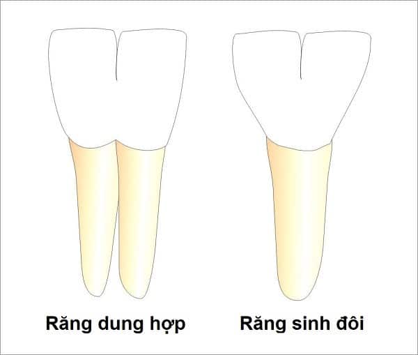 Phân biệt răng sinh đôi và răng dung hợp