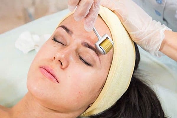 Phương pháp Microneedling