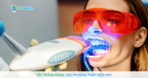 Tẩy trắng răng và các phương pháp phổ biến hiện nay
