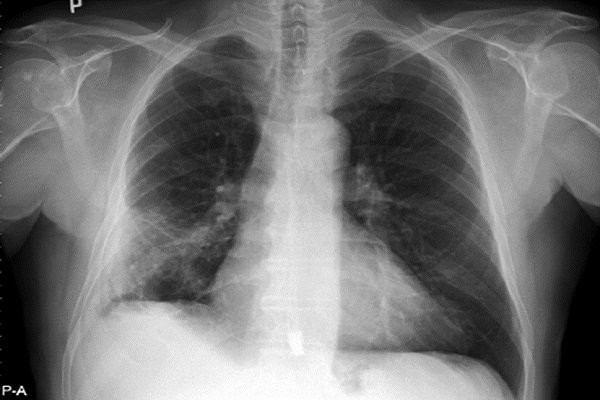 X Quang phổi