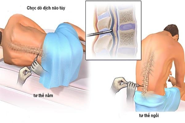 Xét nghiệm dịch não tủy