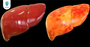 Bệnh gan nhiễm mỡ không do rượu có nguy hiểm không?