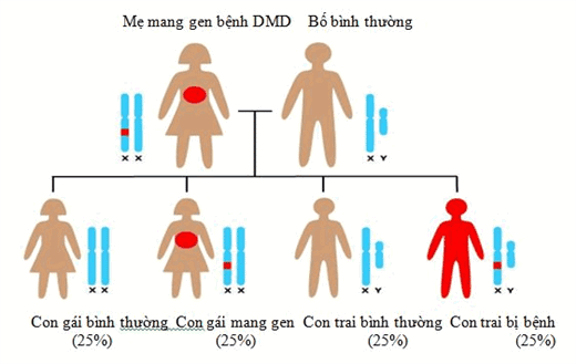 Nguyên nhân của bệnh lý loạn dưỡng cơ Duchenne