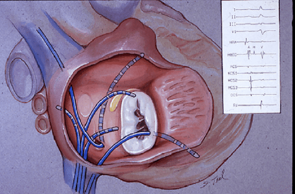Đo điện tim trong tim (intracardiac electrocardiography)