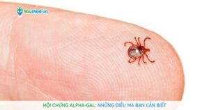 Hội chứng Alpha-gal: Những điều mà bạn cần biết