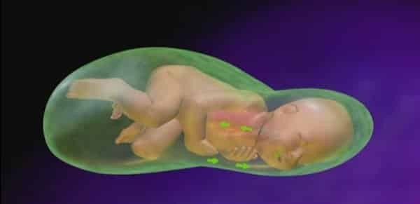 Khi em bé bị căng thẳng do tình trạng thiếu oxy trước hoặc trong khi sinh có thể làm cho bé tổng xuất phân su ra ngoài sớm hơn khi vẫn còn trong tử cung