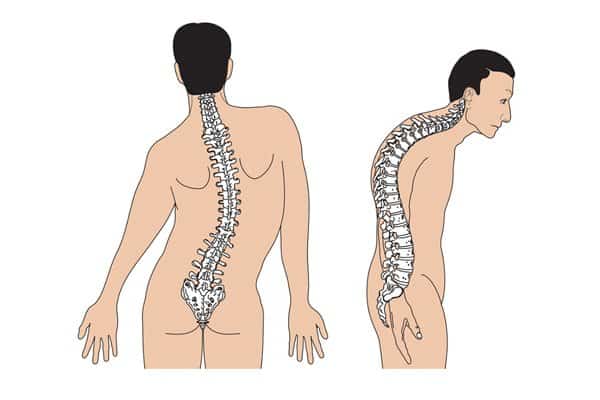 Vẹo cột sống là một trong các biến chứng