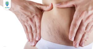 Rạn nứt da ở nam giới và những sự thật đằng sau