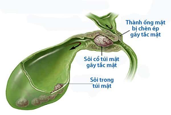 Sỏi là nguyên nhân chính gây viêm túi mật