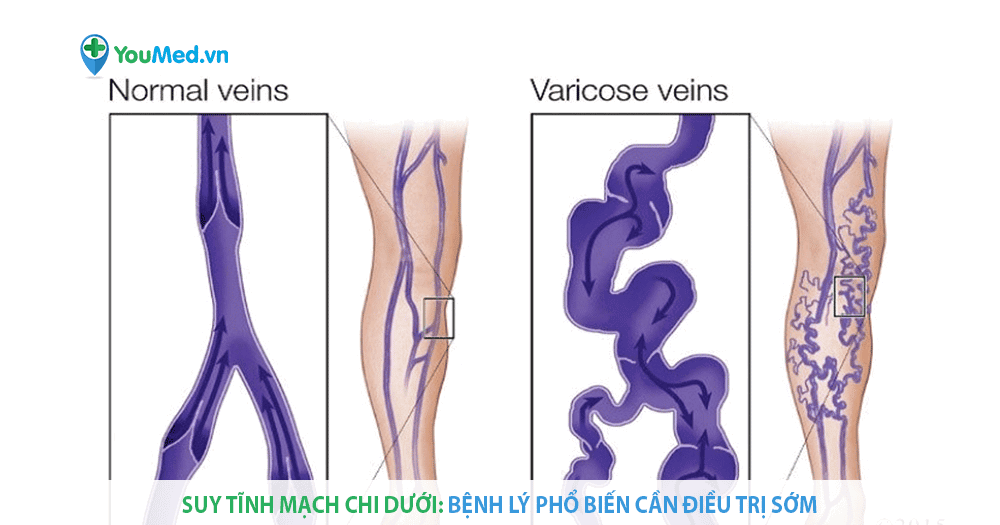 Suy tĩnh mạch chi dưới mạn tính