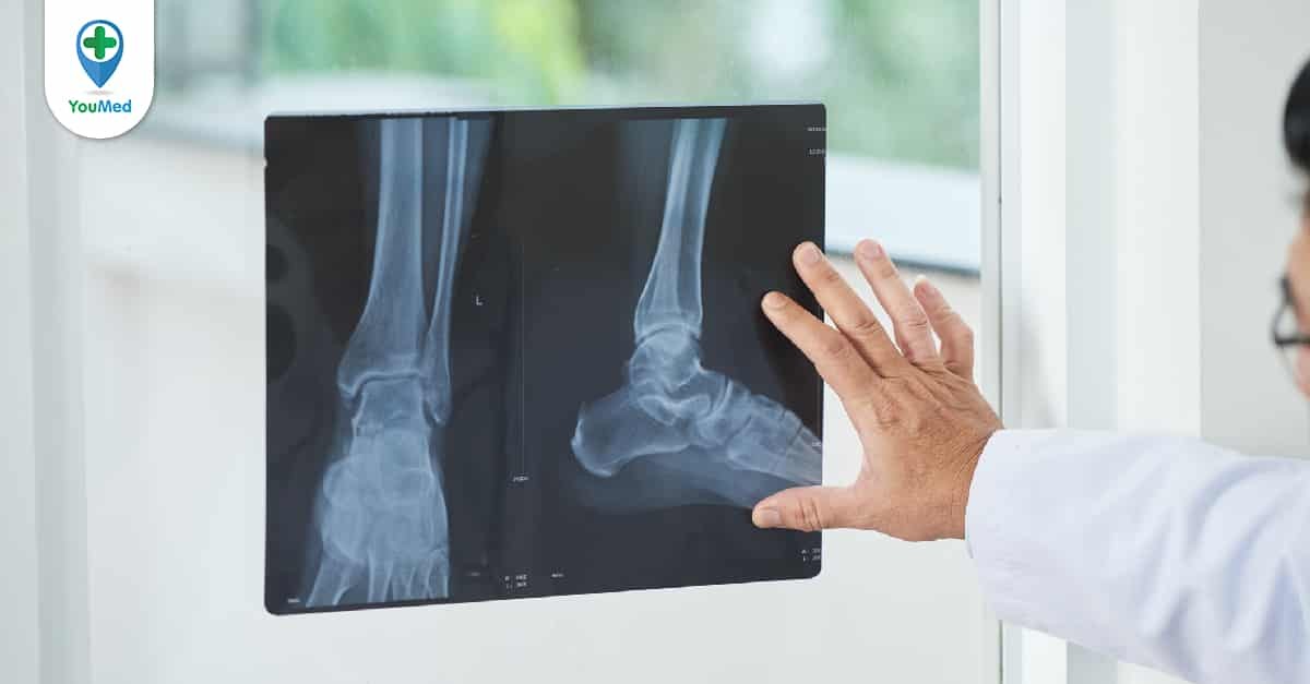 Cách xác định và điều trị chấn thương xương chày? 
