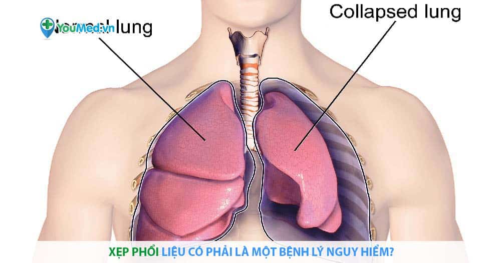 Những triệu chứng xẹp phổi có thể gây ra khó thở không?
