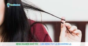 Bệnh nghiện nhổ tóc – Căn bệnh tuy lạ mà không lạ