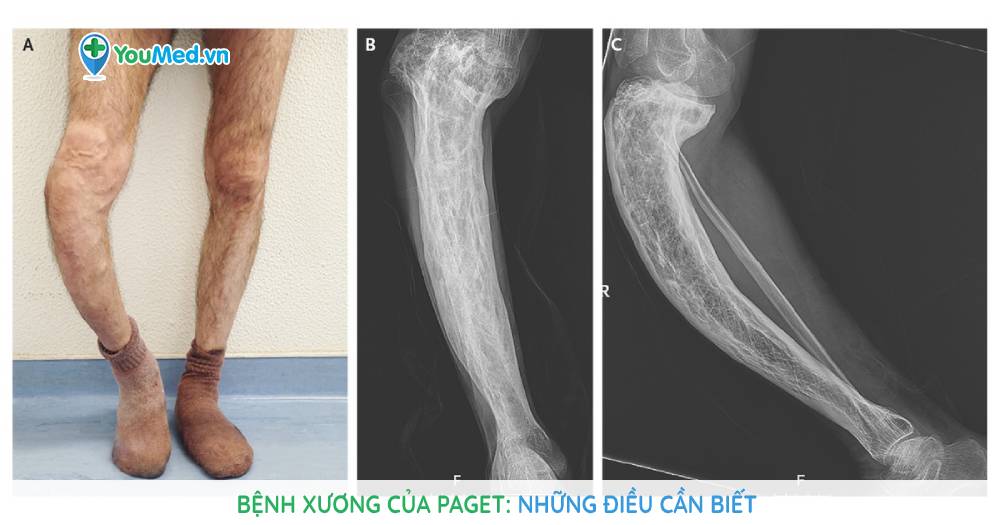 Bệnh xương của Paget: Nguyên nhân, triệu chứng và cách điều trị bệnh