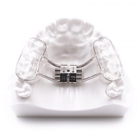 Bonded-RPE-Rapid-Palatal-Expander