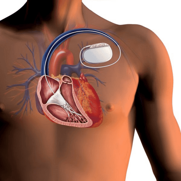 Cấy máy khử rung tim cấy (ICD)