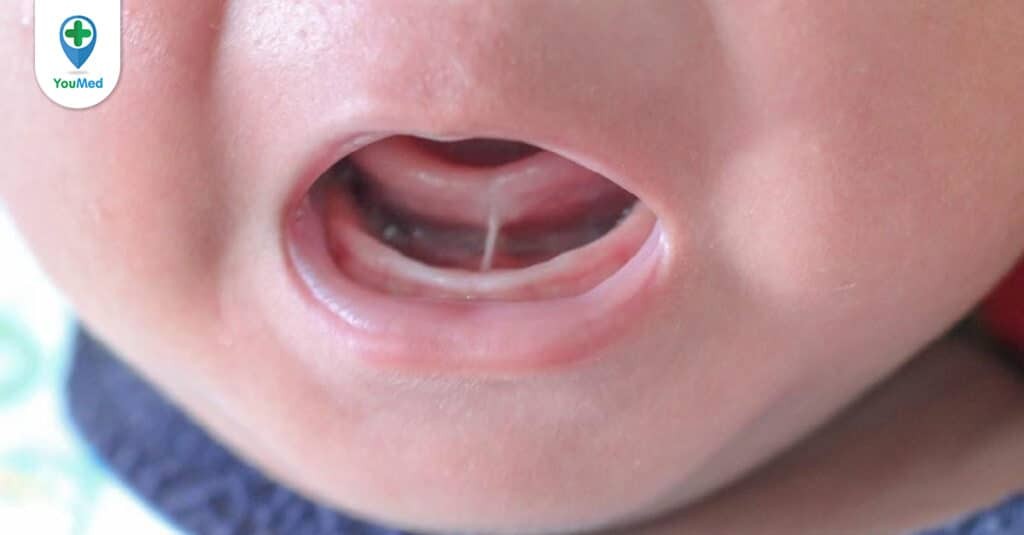 Bệnh cứng lưỡi ảnh hưởng như thế nào đến trẻ?