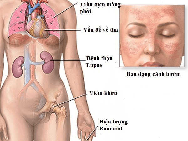  Biểu hiện của Lupus ban đỏ hệ thống