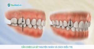 Cắn chéo là gì? Nguyên nhân và cách điều trị