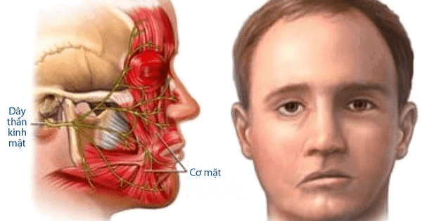 Chứng co giật nửa mặt gây ảnh hưởng tới nhiều nhóm cơ