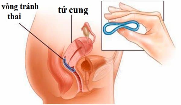 đặt vòng tránh thai