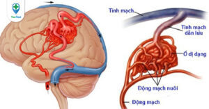 Dị dạng mạch máu não thể hang, bệnh lý mơ hồ tiềm ẩn nhiều nguy cơ