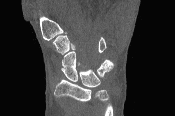  Hình ảnh CT chẩn đoán gãy xương cổ tay