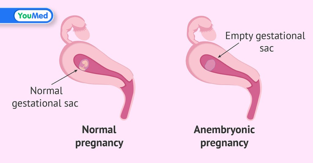Nguyên nhân không có phôi thai: triệu chứng và phương pháp điều trị