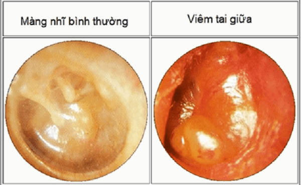 Nhiễm trùng tai có thể gây ảnh hưởng đến thính lực