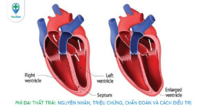 Phì đại thất trái: nguyên nhân, triệu chứng, chẩn đoán và điều trị