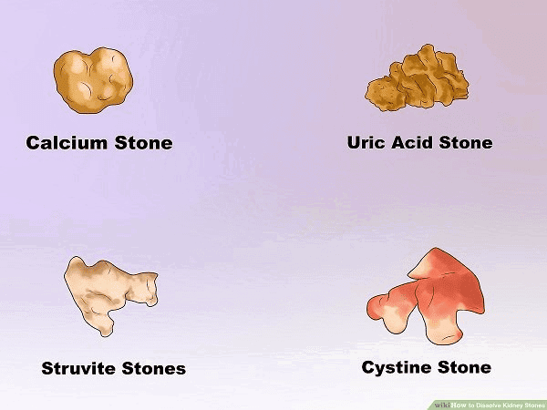  Minh họa các loại sỏi thận chính