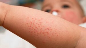 Dấu hiệu nhận biết trẻ sơ sinh bị rôm sảy