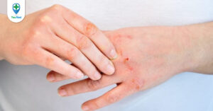 Viêm da thần kinh: Nguyên nhân, triệu chứng và cách điều trị