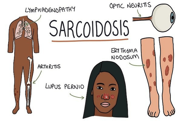  Bệnh sarcoidosis