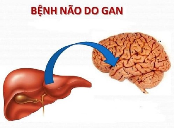 Phát hiện bệnh não gan là trung tâm để chẩn đoán suy gan cấp.