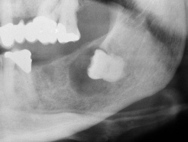 X-quang nang thân răng