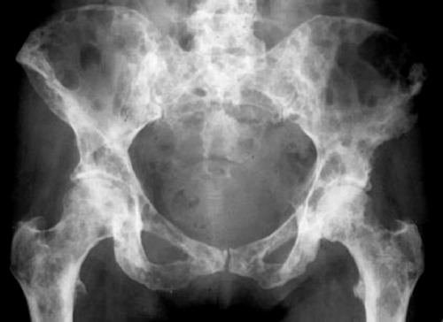 Hình ảnh Xquang xương chậu ở bệnh nhân bị ung thư vú di căn xương chậu