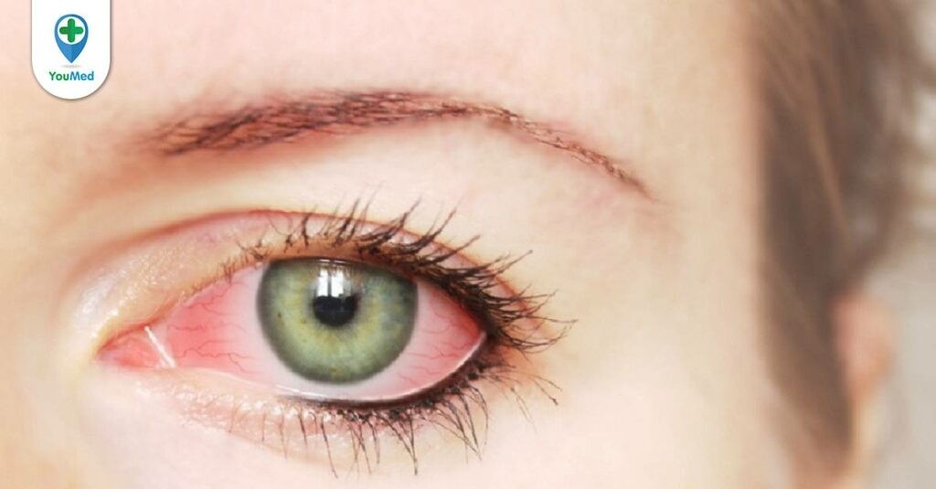 Đau mắt đỏ nhỏ thuốc gì? và lưu ý khi sử dụng từ Bác sĩ