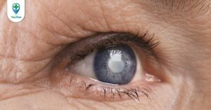Có thuốc nhỏ mắt trị đục thủy tinh thể hay không? Hướng điều trị