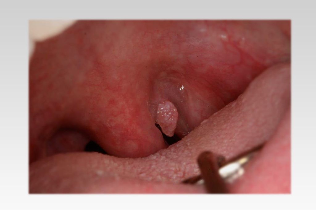 Tổn thương do HPV dạng sùi bông cải trong vòm họng
