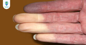 Bệnh Raynaud có nguy hiểm không? Nguyên nhân, dấu hiệu và cách điều trị