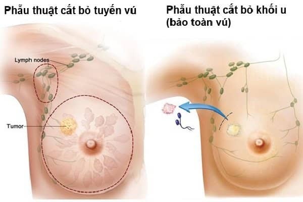 Mô tả phương pháp phẫu thuật trong ung thư vú