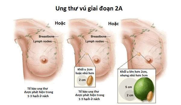 Giai đoạn 2 của ung thư vú