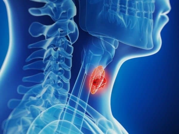Ung thư tuyến giáp thể nhú giai đoạn di căn xa có tỷ lệ sống sót khoảng 74%