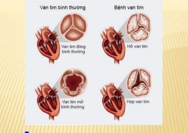 Những hình ảnh bệnh lý van tim