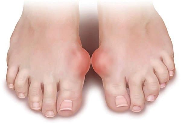 Gout gây viêm sưng ở các khớp, tạo các cục u sưng đỏ đau.