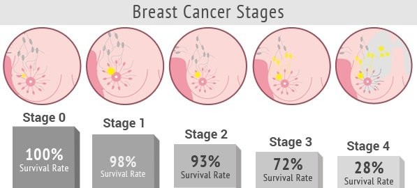 tỉ lệ sống còn sau điều trị của ung thư vú giai đoạn 1 lên đến 98%
