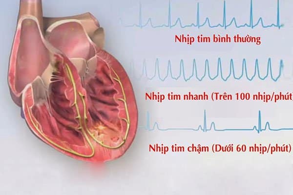 Rối loạn nhịp tim là tình trạng nhịp tim đập bất thường